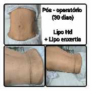 Pós operatório de cirurgia plástica itaguaí